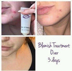 Epoch Blemish Treatment: Soothing botanical-derived blemish gel